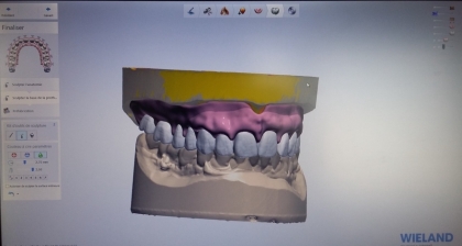 Dental Cap Océan va plus loin dans la prothèse numérique