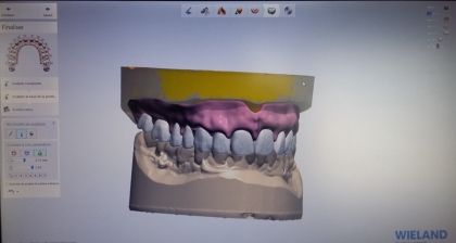 formation prothèse amovible numerique
